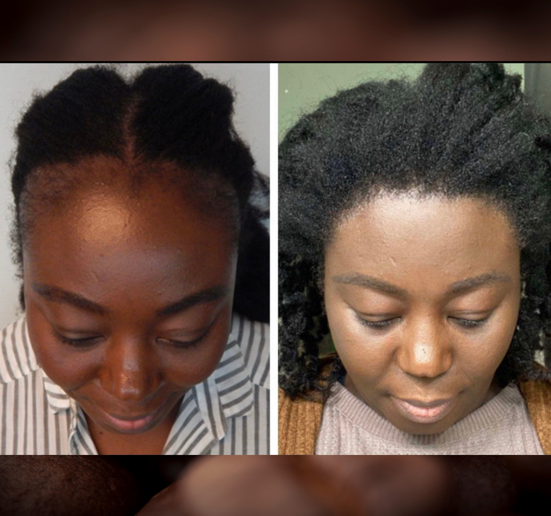 Batana Oil 2oz (Dr.Sebi Approved Hair growth Miracle Oil For Alopecia)