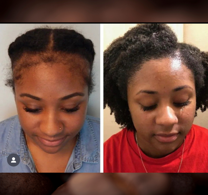 Batana Oil 2oz (Dr.Sebi Approved Hair growth Miracle Oil For Alopecia)